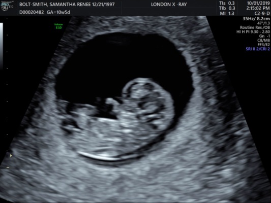 My Due Date Changed Three Times: What Nobody Tells You
